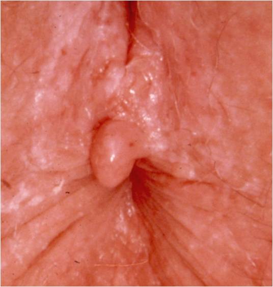 Anal Fissure is a Colorectal Diseases
